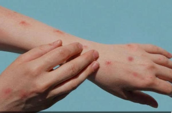 WHO issues new measures to control Mpox spread