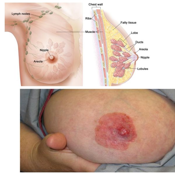 Breast cancer is not a death sentence