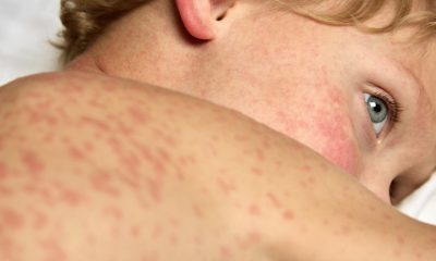 A child infected with measles