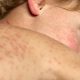 A child infected with measles