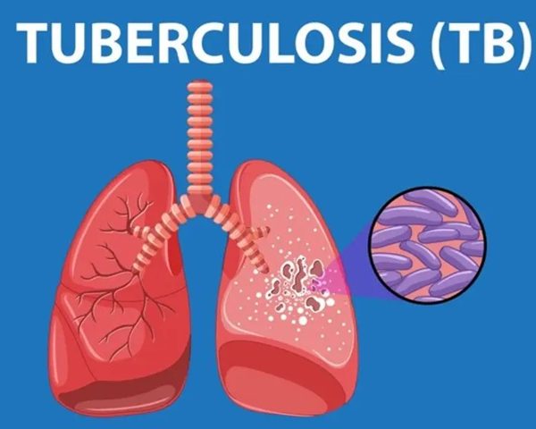 UN and WHO condemn United States over fund slash affecting Tuberculosis (TB)