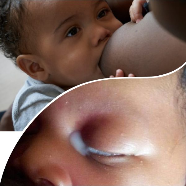 Breastmilk not eye drops! Experts warn against dangerous remedies causing blindness in children