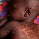 Skin of infected child.