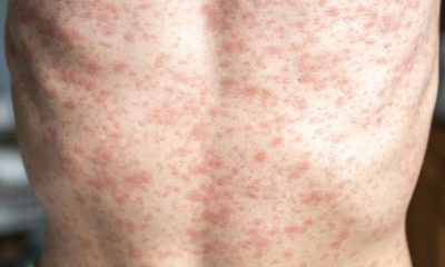 Measles outbreak on the decline in Texas says US Officials