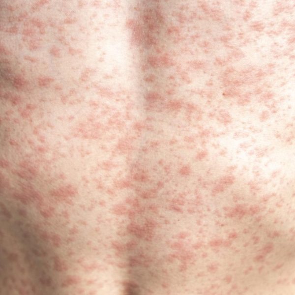 Measles outbreak on the decline in Texas says US Officials