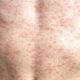 Measles outbreak on the decline in Texas says US Officials