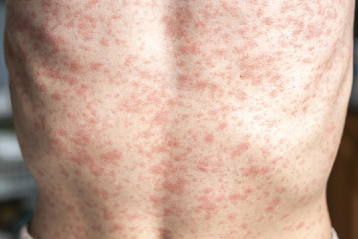 Measles outbreak on the decline in Texas says US Officials