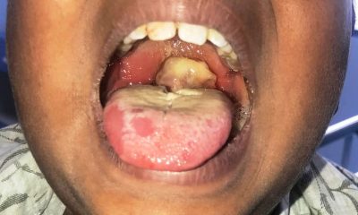 Diphtheria