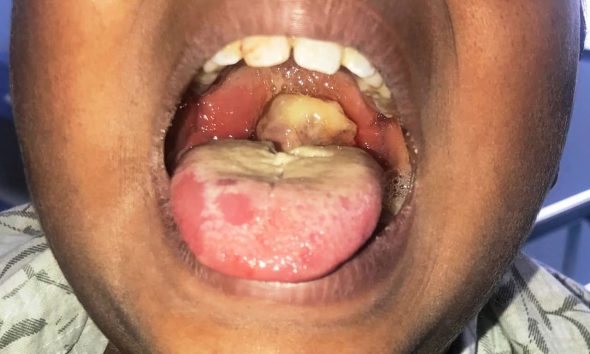Diphtheria