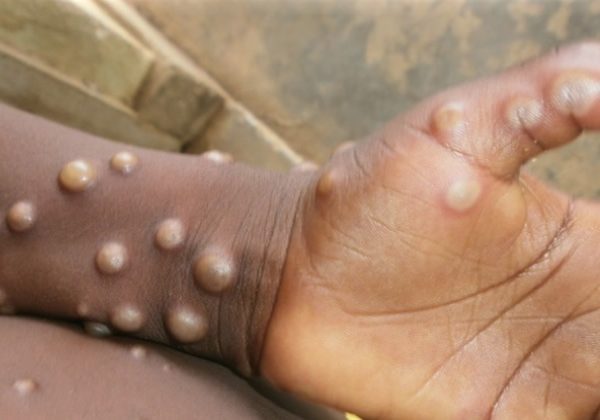 JUST IN – Outbreak Watch: Benue Confirms Mpox Cases, Launches Targeted Jabs