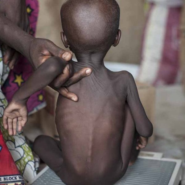 Nigeria Ranks High in Global Malnutrition Crisis, Says Tinubu’s Health Aide