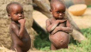Children suffering from kwashiorkor.